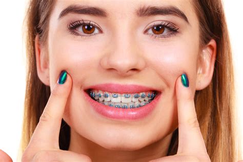 Magical Teeth Braces: A New Era in Orthodontic Treatment